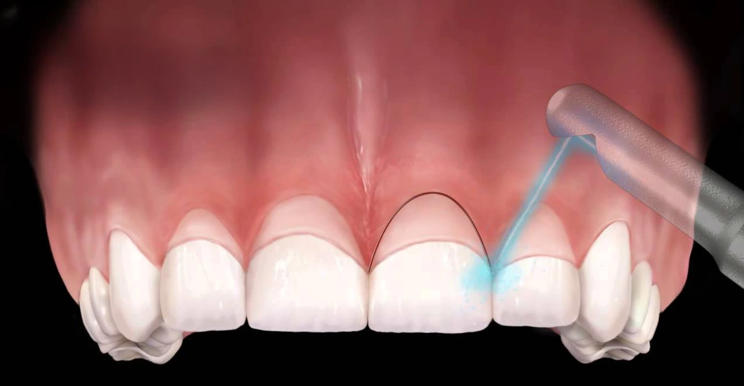 Crown Lengthening for a Gummy Smile 2